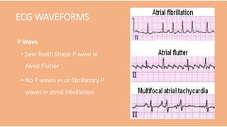ECG WAVEFORMS
P Wave
• Saw Tooth Shape P wave in
Atrial Flutter
• No P waves in or fibrillatory P
waves in atrial Fibrillation
 