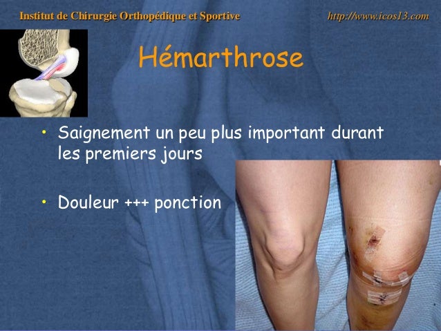hémarthrose genou traitement hémarthrose genou traitement