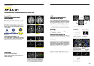 isoFSE is a high-speed 3D imaging function for isovoxels. The flip
angles of refocus pulses of FSE are varied to suppress the influence
from signal strength fluctuations of MultiEchoes and enable high-
definition 3D imaging. The optimization of these application patterns
results in high contrasts achieved with T1WI, T2WI, and FLAIR images.
The high spatial resolution volume data acquired in imaging can be
used to reconstruct images of any cross-section in MPR processing.
isoFSE
High-definition 3Dimagingmade possible by
optimizingRF application patterns
Reconstruction available for any cross-section
Appl i c a ti on/ E CHEL ON S ma r t
Addition of hemodynamicinformationto TOF
Pencil-beam type pre-saturation (BeamSat) pulses based on the
application of local excitation are used in TOF imaging to selectively
suppress some of the blood flow signals required for identification of
the hemodynamics.
If imaging is conducted with BeamSat pulses specified for a target
blood vessel, the flow signals of that vessel can be suppressed, and
the dominant region can be identified. BeamSat pulses can be set to
arbitrary positions and angles using a special GUI. The positions of
BeamSat pulses can be set freely with respect to a target vessel.
Subtraction of images with and without BeamSat pulses can be
displayed in a reversed black-and-white image to visualize it as in
MR-DSA.
BeamSatT
O
F†
Greater visibilityof hemodynamic changes,
for example, due tostenosis.
Without BeamSat With BeamSat
RADAR OFF 2:32 RADAR ON 2:42
Effects of RADARinTOF MRAandGrE T2*WI
RADAR has been applied to GrE sequences using a high-precision
signal correction technology. This has enabled the combined use of
RADAR in all sequences required for routine head examinations.
RADAR OFF 4:28 RADAR ON 4:49
TOF MRA
RADAROFF 4:23(withoutsynchronization) RADAR ON 4:53(without synchronization)
TOF MRA
FSE T2WI
RADAR OFF 2:24 RADAR ON 2:39
SE T1WI
RADAR mitigates motion artifacts enhancing ease of use when
imaging with many sequences, all receiver coils, and arbitrary
cross-sections. RADAR can be used in combination with high-
speed imaging. ECHELON Smart supports TOF and GrE sequences
and is compatible with the combined use of RADAR for most of the
sequences required for routine head examinations, thus realizing
"All Around RADAR."
AllAroundRADAR
CombineduseofRADARinsequencesrequiredfor
routineheadexaminations
RADAR
Many coils/oblique
Free sequences
Compatible with
high-speed imaging Compatible with TOF/GE
[Routine head imaging] Newly added
TOF T2*WI
T1W1 T2W1 FLAIR PDI DWI
RADAR
RAPID
All Around
RADAR
High-precision control of pre-saturation
pulses using the spiral-type two-
dimensionalexcitation method
[BeamSat pulse excitation chart
(schematicdiagram)]
RF
Gy
Gx
Time
Beam-formpre-saturationpulse realized
byahighsystemperformance
[BeamSat pulse excitationprofile]
Y
X
FA
Subtraction image
(reversed black-and-white image)
[Special GUIfor BeamSat] BeamSat pulse setting example
Inthe BeamSatdisplay, the continuous line on the left ICA
represents a nearer part and the broken SAGcross-section: Position contacting
line a part farther than the scanogram; nasal root/sella turcica
thehatchedpartis a cross-sectionbetween AX cross-section: Position contacting
a BeamSat and a scanogram. pyramid/clivus
Diagnosis of carotid artery plaque characteristics requires an MR
image with high T1 contrast.
PlaqueImaging†
For diagnosis of plaquecharacteristics
The asynchronous RADAR-SE method By normalizing the ROIsignal strength to
to which Radial Scan has been applied a reference, the SIR Map displays a color
maintains a constant TR without influence map of signal strength ratios. Applying
from pulsation, and can conduct imaging this to Plaque Imaging could facilitate
with a high T1 contrast appropriate for diagnosis of the plaque characteristics.
diagnosisofplaquecharacteristics.
RADAR-SE
TR:500ms,TE:15ms
Asynchronous RADAR-SEmethod
MRIplaque imaging ofthe carotid artery
200
H
e
m
o
r
r
h
a
g
e
150
Lipid
120
Fibrous
100
SIR Map
Color map ofthe carotid artery plaque
ROI
† Optional
1
1 1
2
Reference
Smart
APPLICA
TION
Applicationswhichenhance the usefulness of head and thoraco-abdominal images.
 