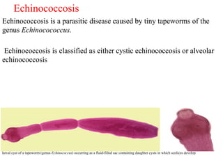 Echinococcosis MLT.pptx study parasitology | PPTX