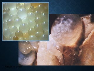 Daughter cysts
 