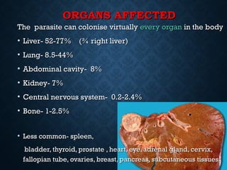 ORGANS AFFECTEDORGANS AFFECTED
The parasite can colonise virtuallyThe parasite can colonise virtually every organevery organ in the bodyin the body
• Liver- 52-77% (¾ right liver)Liver- 52-77% (¾ right liver)
• Lung- 8.5-44%Lung- 8.5-44%
• Abdominal cavity- 8%Abdominal cavity- 8%
• Kidney- 7%Kidney- 7%
• Central nervous system- 0.2-2.4%Central nervous system- 0.2-2.4%
• Bone- 1-2.5%Bone- 1-2.5%
• Less common- spleen,Less common- spleen,
bladder, thyroid, prostate , heart, eye, adrenal gland, cervix,bladder, thyroid, prostate , heart, eye, adrenal gland, cervix,
fallopian tube, ovaries, breast, pancreas, subcutaneous tissuesfallopian tube, ovaries, breast, pancreas, subcutaneous tissues..
 