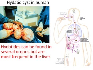 Hydatid cyst in human
Hydatides can be found in
several organs but are
most frequent in the liver
 