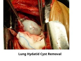 Lung Hydatid Cyst Removal
 