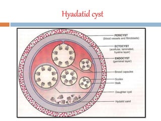 Hyadatid cyst
 