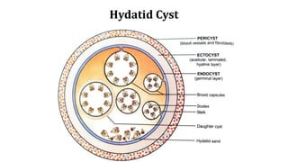 Hydatid Cyst
 
