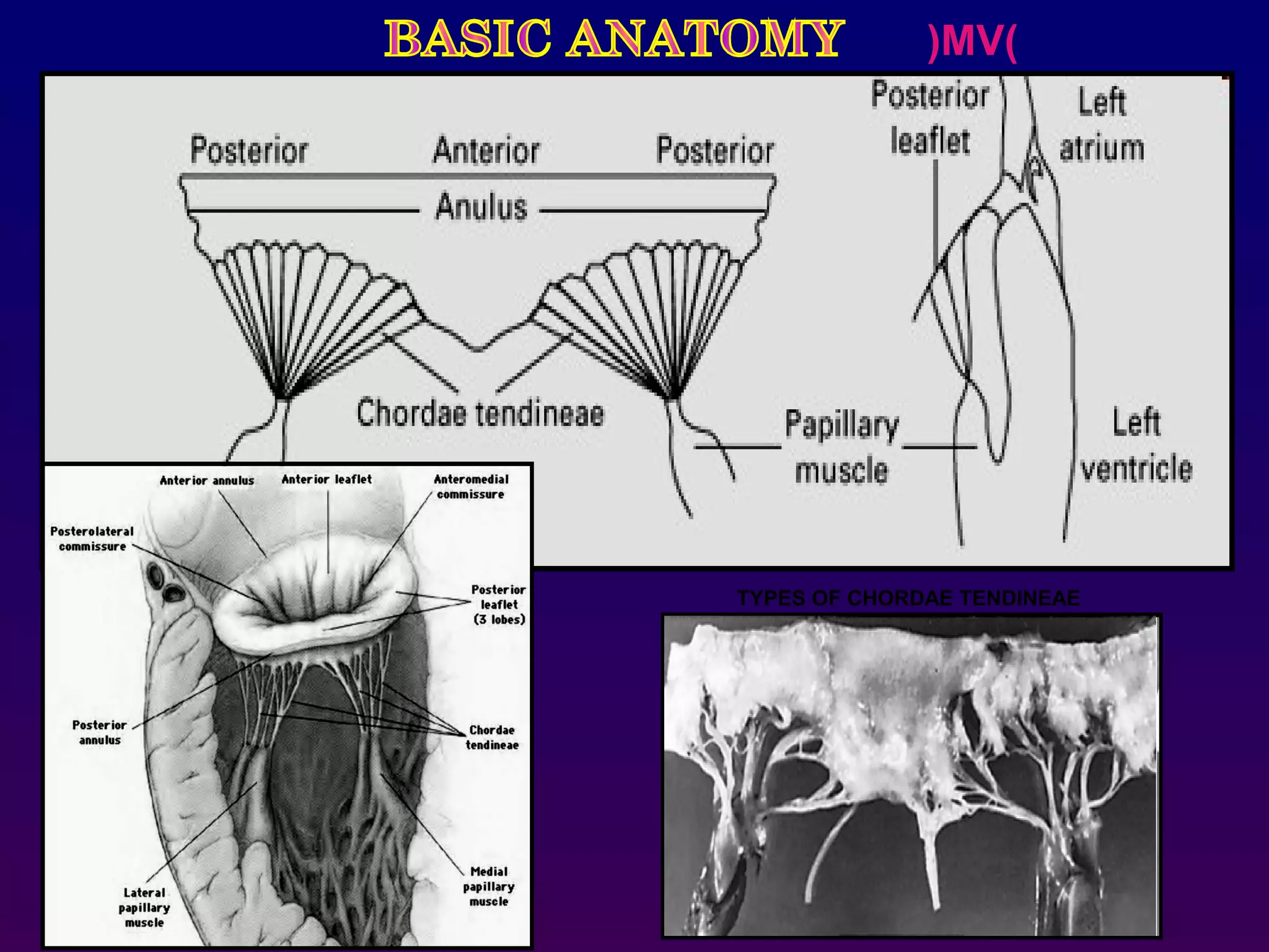 )MV(
TYPES OF CHORDAE TENDINEAE
 
