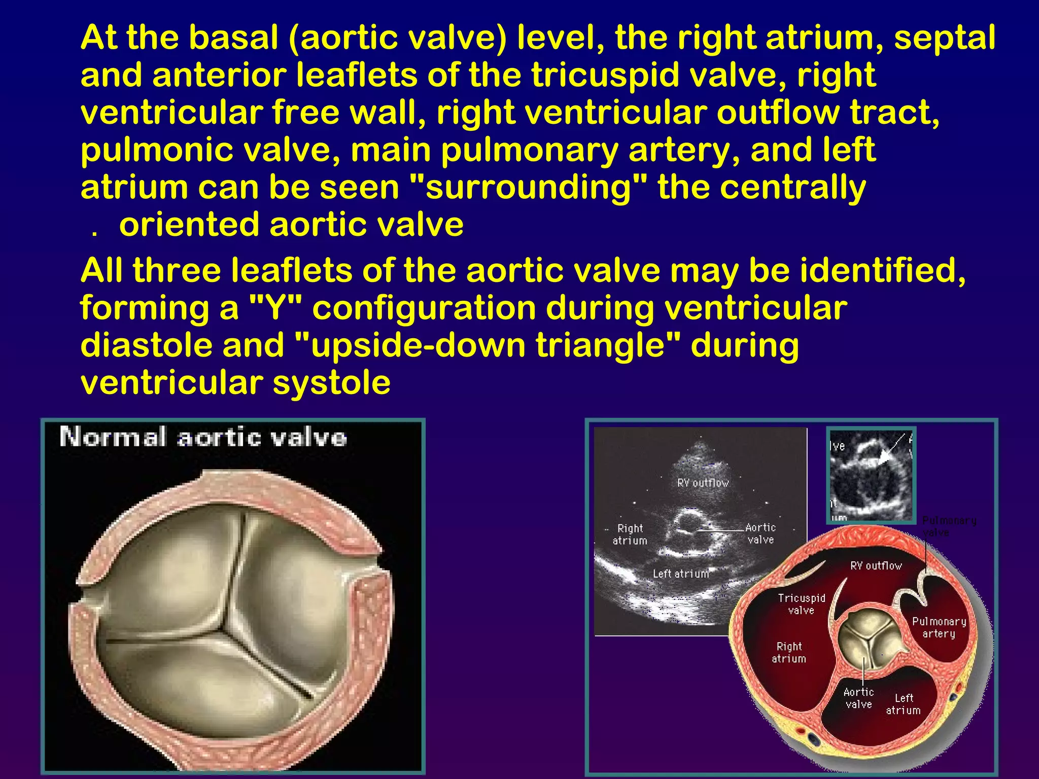 At the basal (aortic valve) level, the right atrium, septal
and anterior leaflets of the tricuspid valve, right
ventricular free wall, right ventricular outflow tract,
pulmonic valve, main pulmonary artery, and left
atrium can be seen "surrounding" the centrally
oriented aortic valve.
All three leaflets of the aortic valve may be identified,
forming a "Y" configuration during ventricular
diastole and "upside-down triangle" during
ventricular systole
 