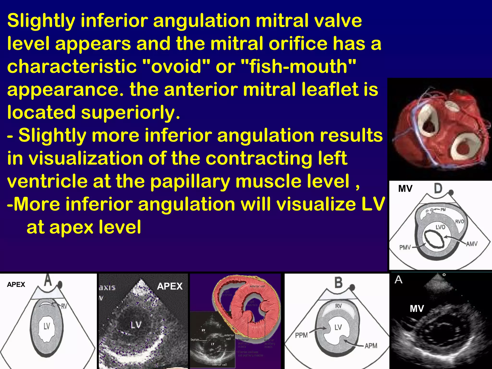 Slightly inferior angulation mitral valve
level appears and the mitral orifice has a
characteristic "ovoid" or "fish-mouth"
appearance. the anterior mitral leaflet is
located superiorly.
- Slightly more inferior angulation results
in visualization of the contracting left
ventricle at the papillary muscle level ,
-More inferior angulation will visualize LV
at apex level
MV
MV
APEXAPEX
 