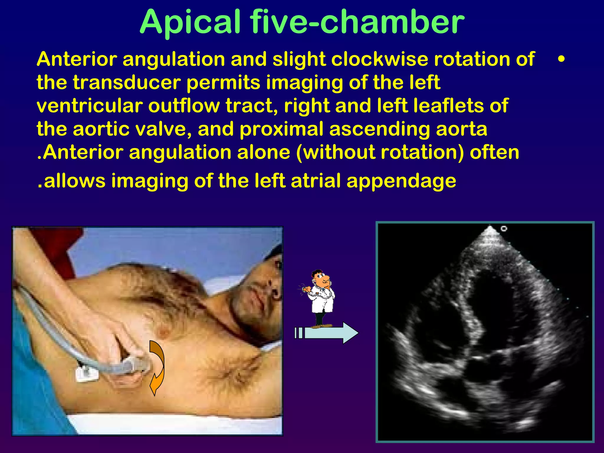 Apical five-chamber
•Anterior angulation and slight clockwise rotation of
the transducer permits imaging of the left
ventricular outflow tract, right and left leaflets of
the aortic valve, and proximal ascending aorta
.Anterior angulation alone (without rotation) often
allows imaging of the left atrial appendage.
 
