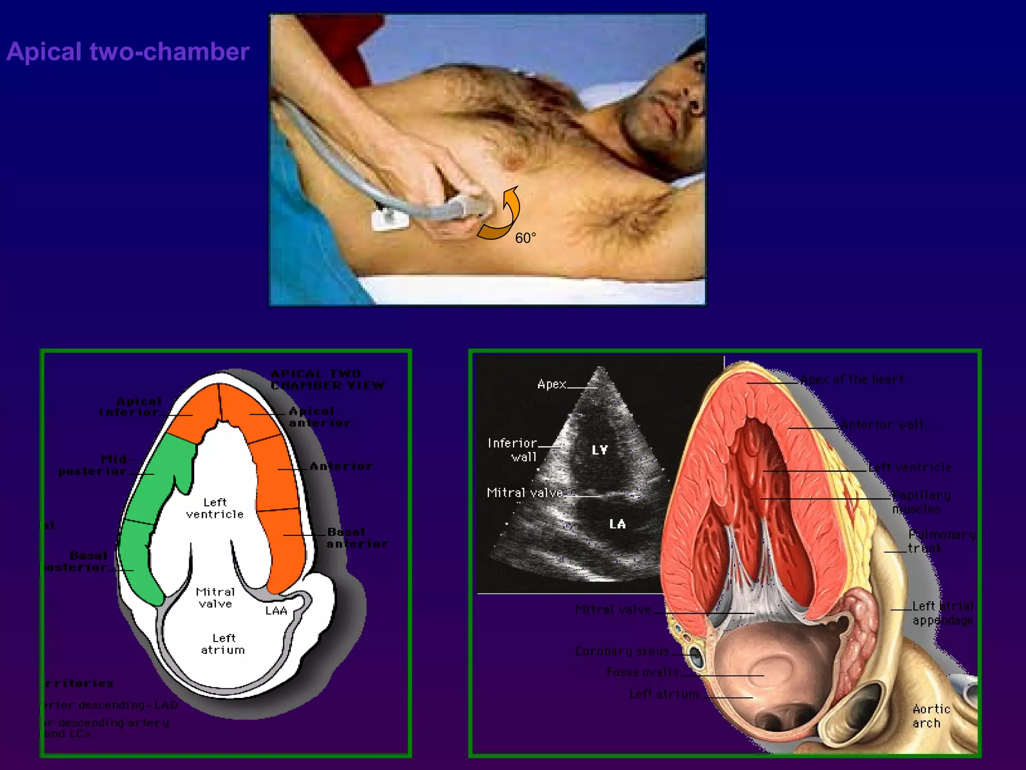 Apical two-chamber
60°
 