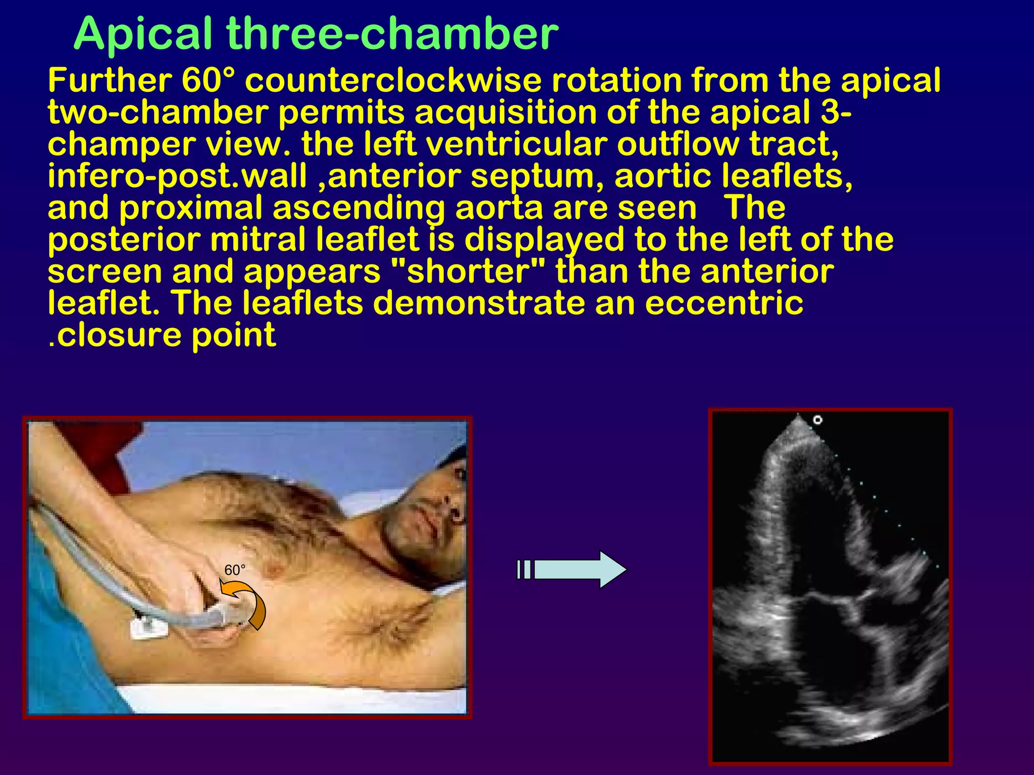 Apical three-chamber
Further 60° counterclockwise rotation from the apical
two-chamber permits acquisition of the apical 3-
champer view. the left ventricular outflow tract,
infero-post.wall ,anterior septum, aortic leaflets,
and proximal ascending aorta are seen The
posterior mitral leaflet is displayed to the left of the
screen and appears "shorter" than the anterior
leaflet. The leaflets demonstrate an eccentric
closure point.
60°
 