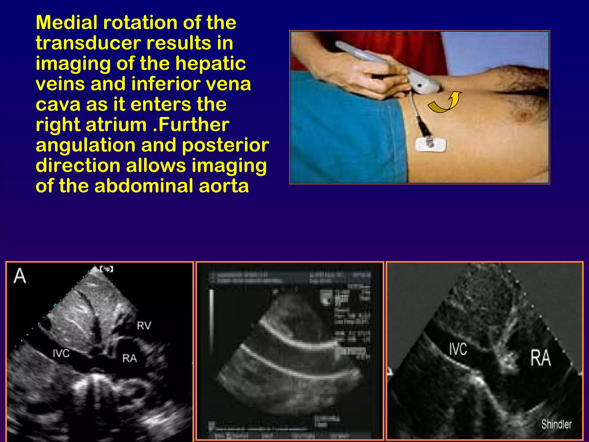 Medial rotation of the
transducer results in
imaging of the hepatic
veins and inferior vena
cava as it enters the
right atrium .Further
angulation and posterior
direction allows imaging
of the abdominal aorta
 