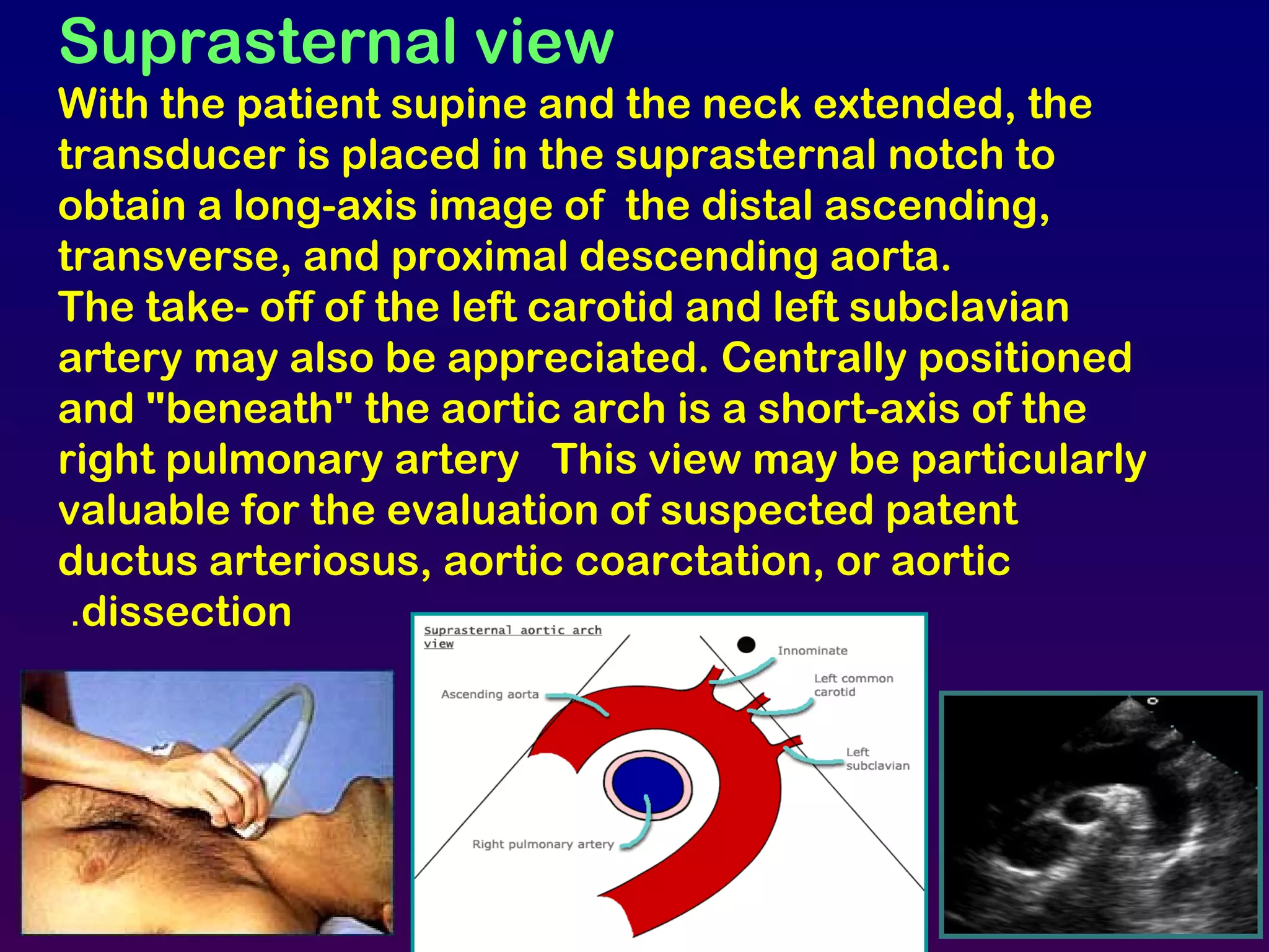 Suprasternal view
With the patient supine and the neck extended, the
transducer is placed in the suprasternal notch to
obtain a long-axis image of the distal ascending,
transverse, and proximal descending aorta.
The take- off of the left carotid and left subclavian
artery may also be appreciated. Centrally positioned
and "beneath" the aortic arch is a short-axis of the
right pulmonary artery This view may be particularly
valuable for the evaluation of suspected patent
ductus arteriosus, aortic coarctation, or aortic
dissection.
AV
A.AO
 