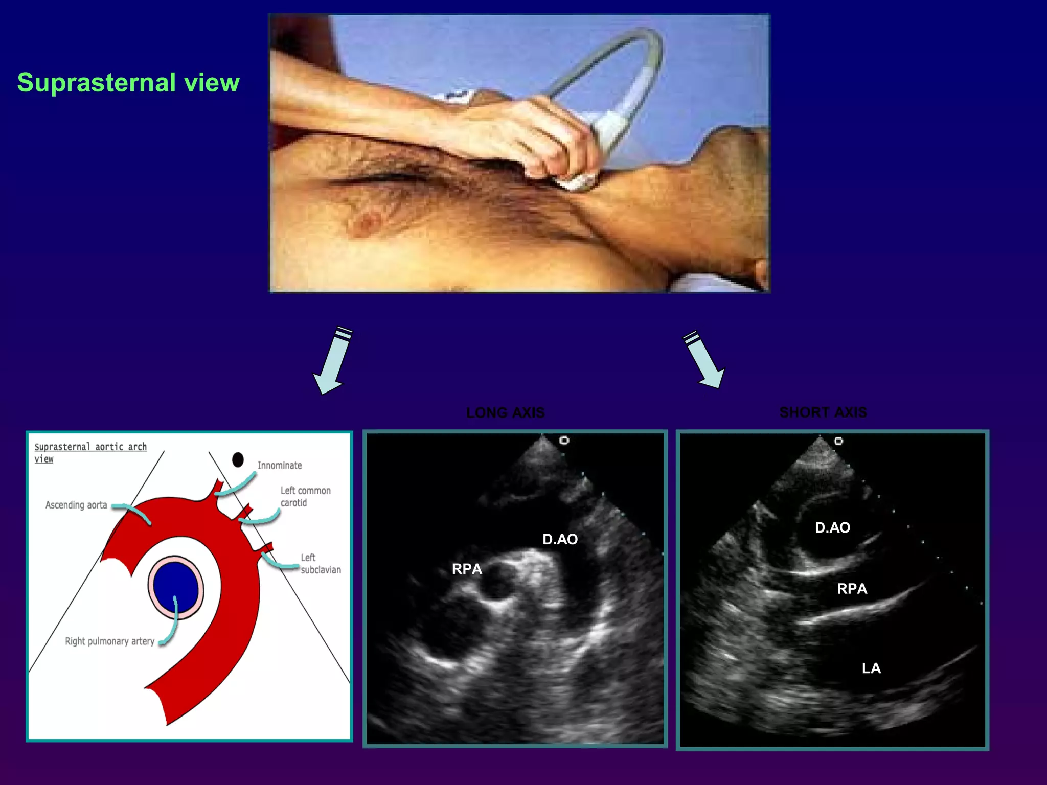 RPA
D.AO
RPA
D.AO
Suprasternal view
LONG AXIS SHORT AXIS
LA
 