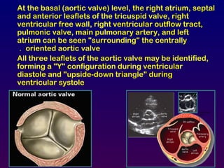 At the basal (aortic valve) level, the right atrium, septal
and anterior leaflets of the tricuspid valve, right
ventricular free wall, right ventricular outflow tract,
pulmonic valve, main pulmonary artery, and left
atrium can be seen "surrounding" the centrally
oriented aortic valve.
All three leaflets of the aortic valve may be identified,
forming a "Y" configuration during ventricular
diastole and "upside-down triangle" during
ventricular systole
 