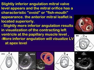 Slightly inferior angulation mitral valve
level appears and the mitral orifice has a
characteristic "ovoid" or "fish-mouth"
appearance. the anterior mitral leaflet is
located superiorly.
- Slightly more inferior angulation results
in visualization of the contracting left
ventricle at the papillary muscle level ,
-More inferior angulation will visualize LV
at apex level
MV
MV
APEXAPEX
 