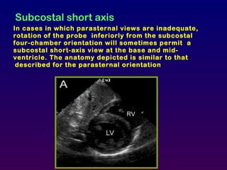 Subcostal short axis
In cases in which parasternal views are inadequate,
rotation of the probe inferiorly from the subcostal
four-chamber orientation will sometimes permit a
subcostal short-axis view at the base and mid-
ventricle. The anatomy depicted is similar to that
described for the parasternal orientation
 