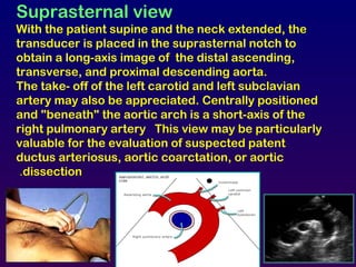 Suprasternal view
With the patient supine and the neck extended, the
transducer is placed in the suprasternal notch to
obtain a long-axis image of the distal ascending,
transverse, and proximal descending aorta.
The take- off of the left carotid and left subclavian
artery may also be appreciated. Centrally positioned
and "beneath" the aortic arch is a short-axis of the
right pulmonary artery This view may be particularly
valuable for the evaluation of suspected patent
ductus arteriosus, aortic coarctation, or aortic
dissection.
AV
A.AO
 