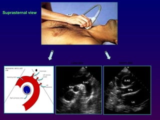 RPA
D.AO
RPA
D.AO
Suprasternal view
LONG AXIS SHORT AXIS
LA
 