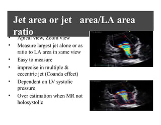 Echo. assessment of MR by Dr.Preetam.pptx