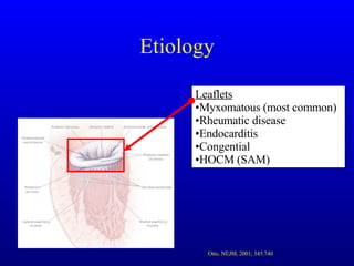 Etiology Leaflets Myxomatous (most common) Rheumatic disease Endocarditis Congential HOCM (SAM) Otto, NEJM, 2001; 345:740 