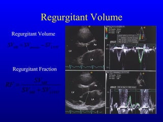 Regurgitant Volume Regurgitant Volume Regurgitant Fraction 