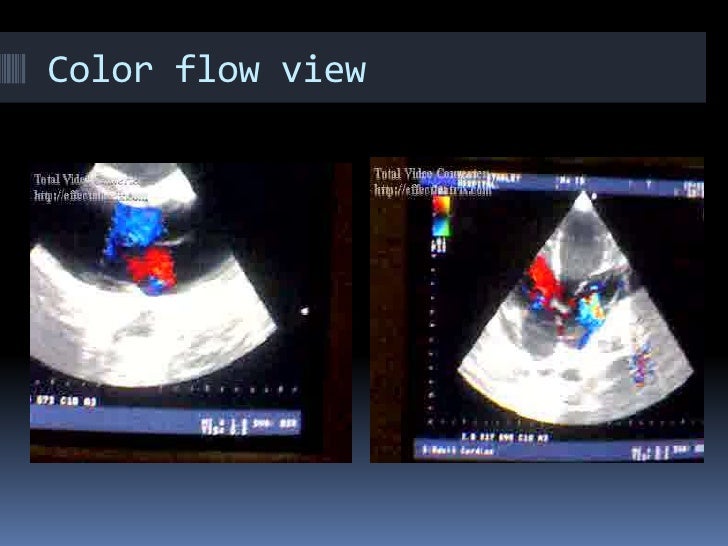 Echocardiogram Basics