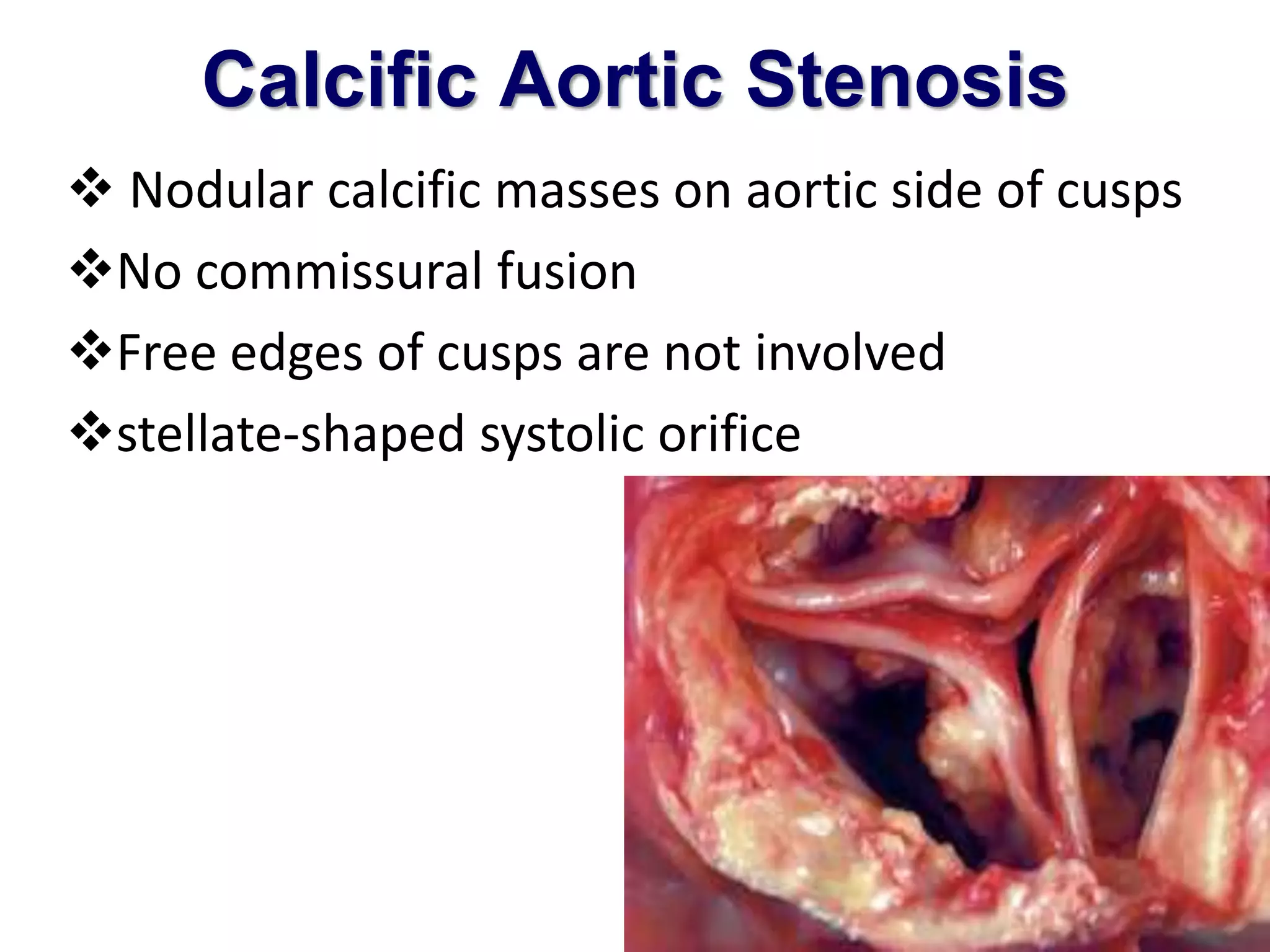 Calcific Aortic Stenosis 
 Nodular calcific masses on aortic side of cusps 
No commissural fusion 
Free edges of cusps are not involved 
stellate-shaped systolic orifice 
 