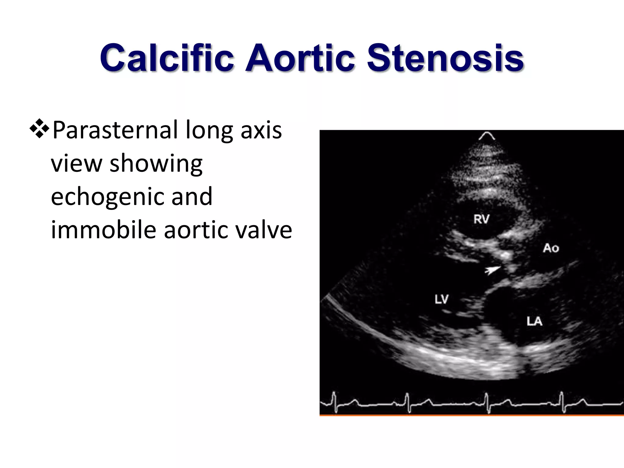 Calcific Aortic Stenosis 
Parasternal long axis 
view showing 
echogenic and 
immobile aortic valve 
 