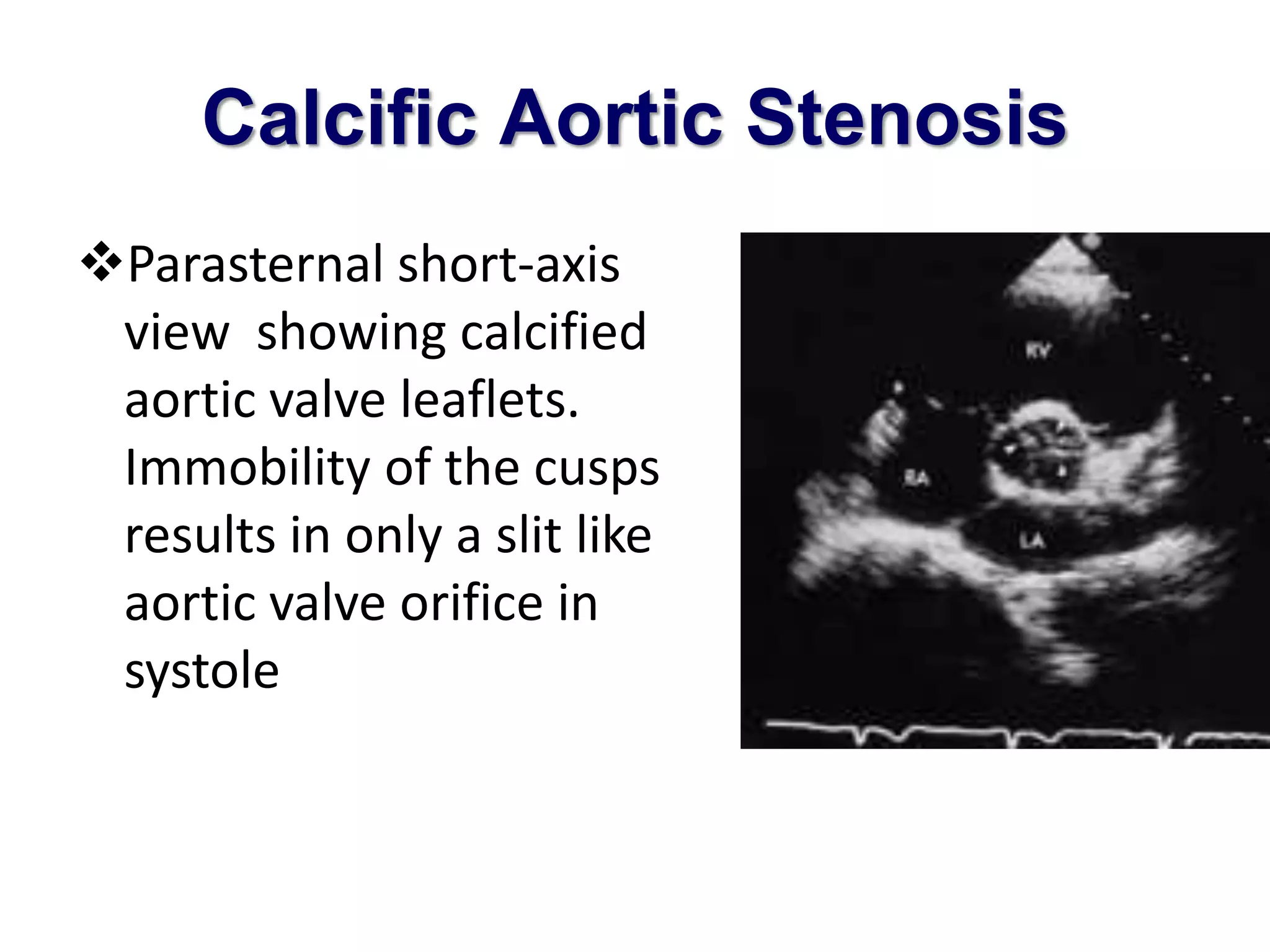 Calcific Aortic Stenosis 
Parasternal short-axis 
view showing calcified 
aortic valve leaflets. 
Immobility of the cusps 
results in only a slit like 
aortic valve orifice in 
systole 
 
