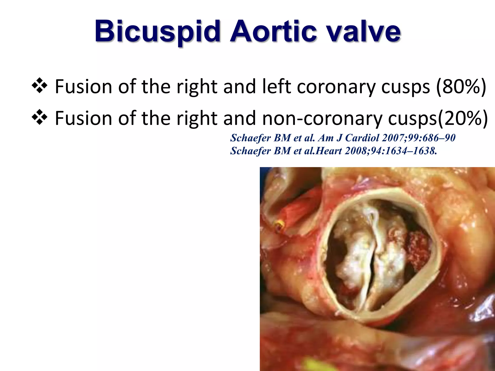 Bicuspid Aortic valve 
 Fusion of the right and left coronary cusps (80%) 
 Fusion of the right and non-coronary cusps(20%) 
Schaefer BM et al. Am J Cardiol 2007;99:686–90 
Schaefer BM et al.Heart 2008;94:1634–1638. 
 