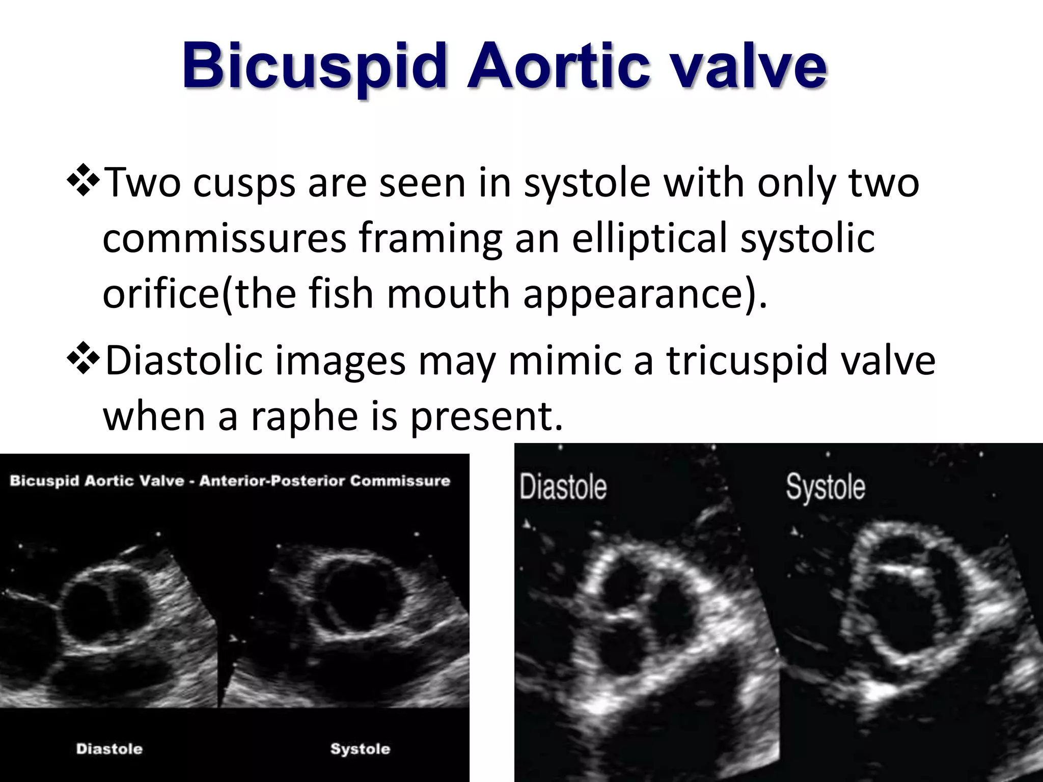 Bicuspid Aortic valve 
Two cusps are seen in systole with only two 
commissures framing an elliptical systolic 
orifice(the fish mouth appearance). 
Diastolic images may mimic a tricuspid valve 
when a raphe is present. 
 