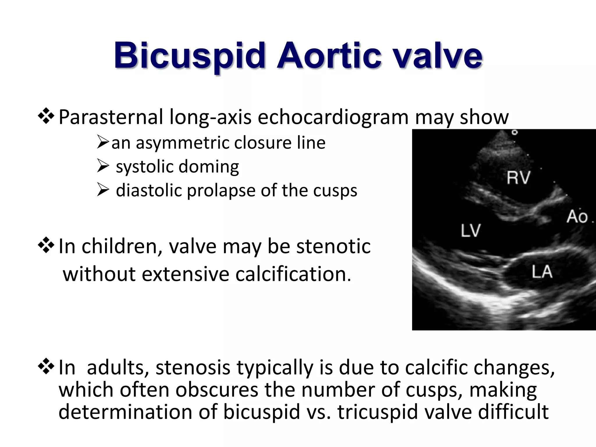 Bicuspid Aortic valve 
Parasternal long-axis echocardiogram may show 
an asymmetric closure line 
 systolic doming 
 diastolic prolapse of the cusps 
In children, valve may be stenotic 
without extensive calcification. 
In adults, stenosis typically is due to calcific changes, 
which often obscures the number of cusps, making 
determination of bicuspid vs. tricuspid valve difficult 
 