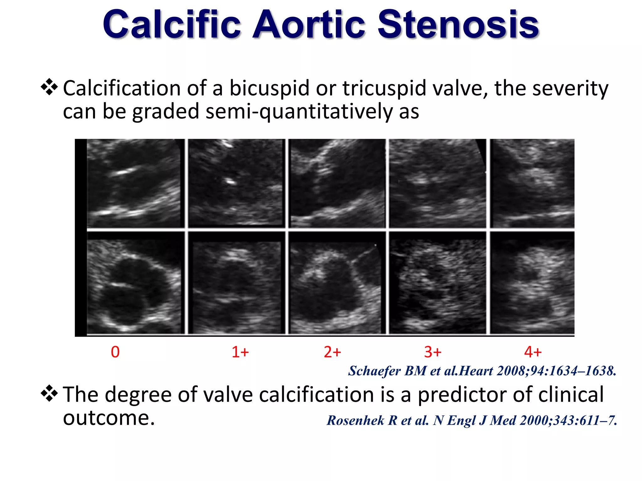 Calcific Aortic Stenosis 
Calcification of a bicuspid or tricuspid valve, the severity 
can be graded semi-quantitatively as 
0 1+ 2+ 3+ 4+ 
Schaefer BM et al.Heart 2008;94:1634–1638. 
The degree of valve calcification is a predictor of clinical 
outcome. Rosenhek R et al. N Engl J Med 2000;343:611–7. 
 