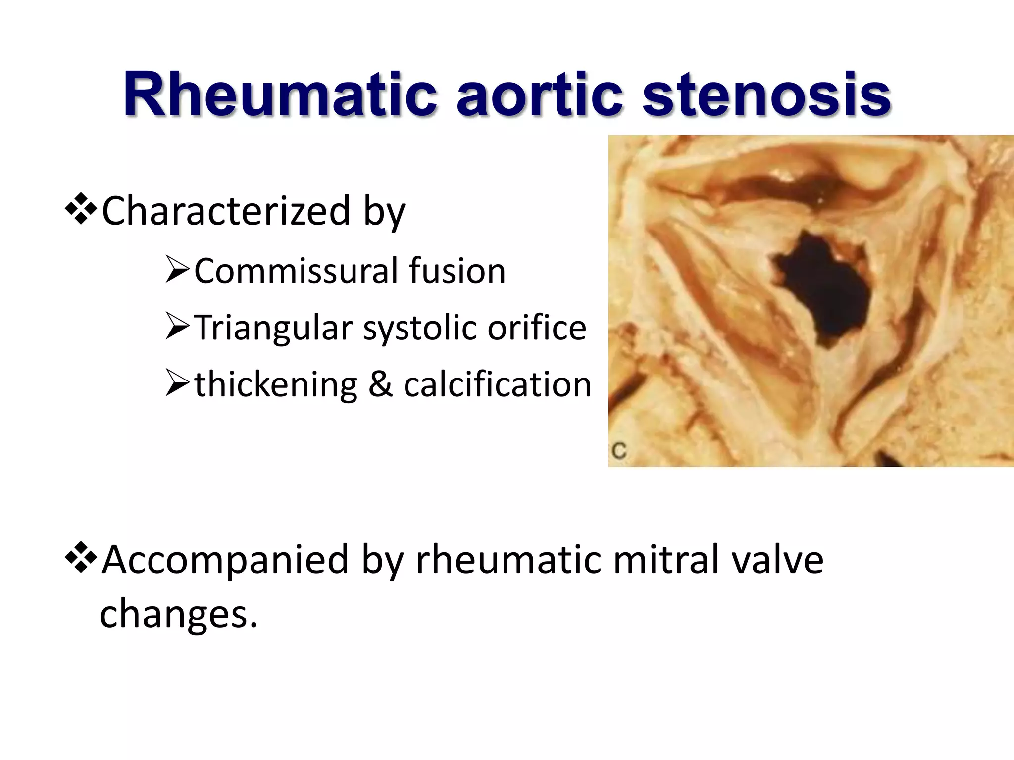 Rheumatic aortic stenosis 
Characterized by 
Commissural fusion 
Triangular systolic orifice 
thickening & calcification 
Accompanied by rheumatic mitral valve 
changes. 
 