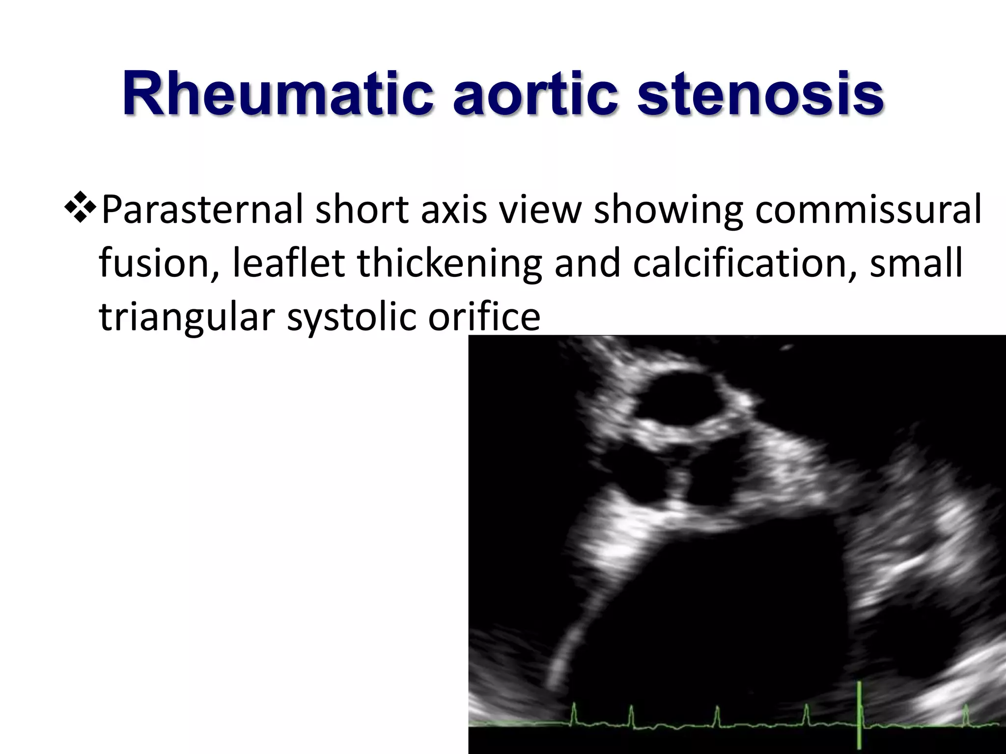 Rheumatic aortic stenosis 
Parasternal short axis view showing commissural 
fusion, leaflet thickening and calcification, small 
triangular systolic orifice 
 