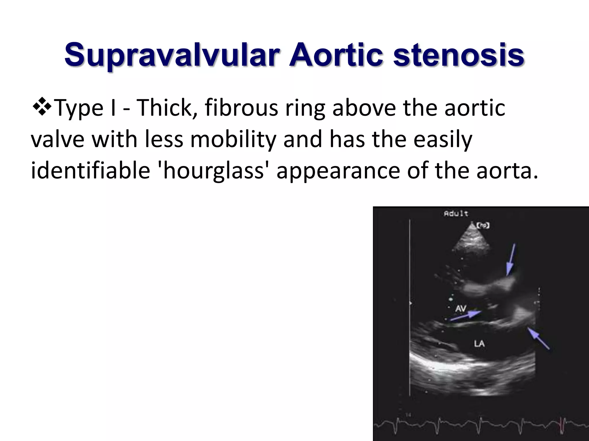 Supravalvular Aortic stenosis 
Type I - Thick, fibrous ring above the aortic 
valve with less mobility and has the easily 
identifiable 'hourglass' appearance of the aorta. 
 