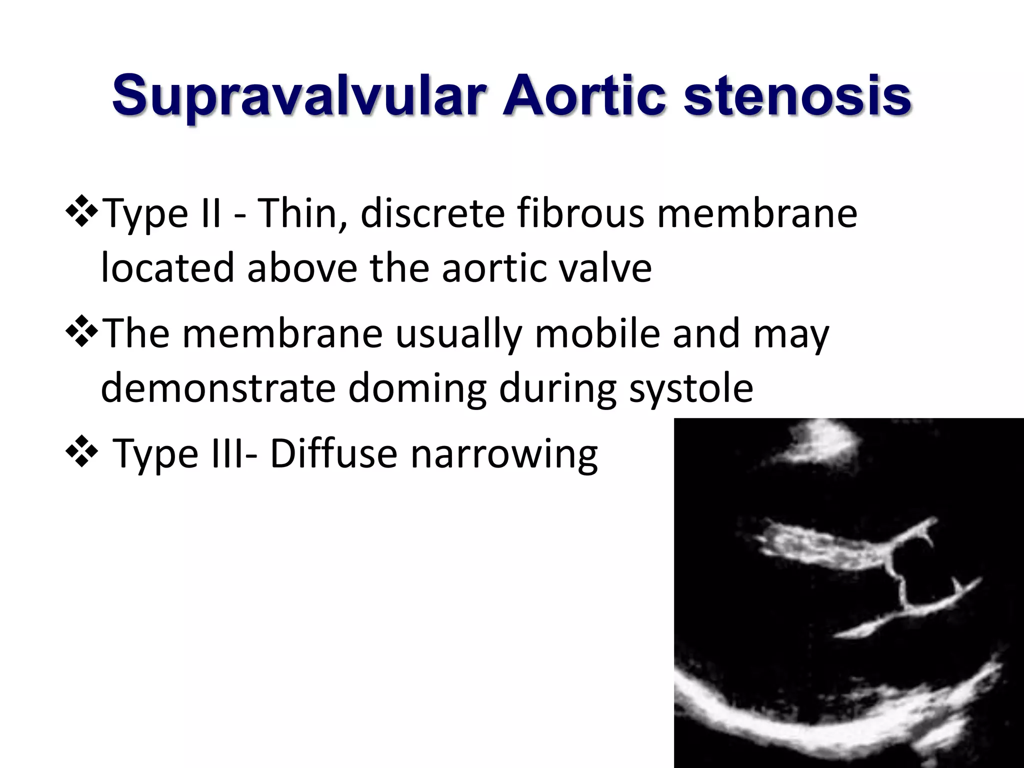 Supravalvular Aortic stenosis 
Type II - Thin, discrete fibrous membrane 
located above the aortic valve 
The membrane usually mobile and may 
demonstrate doming during systole 
 Type III- Diffuse narrowing 
 