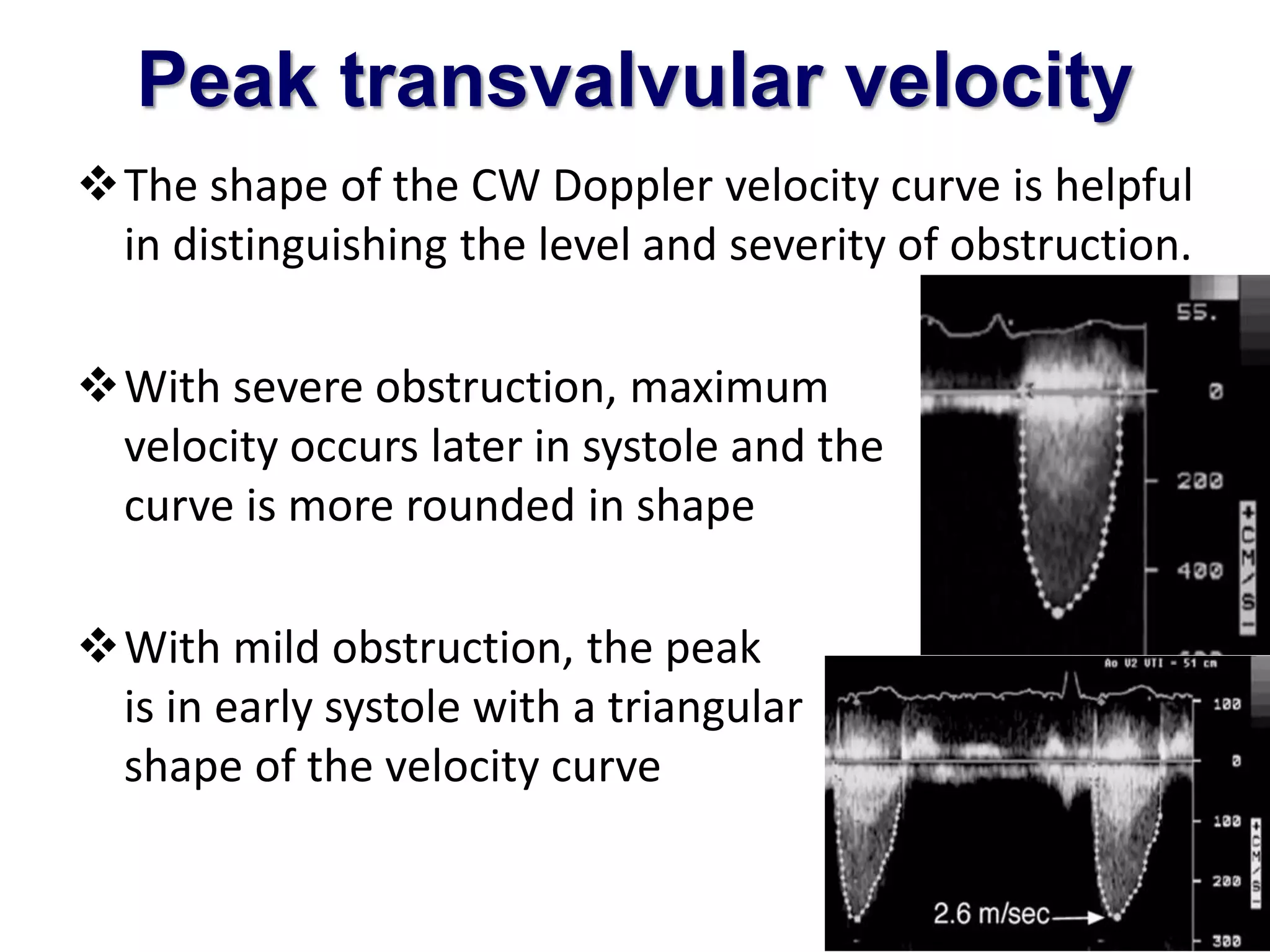 Peak transvalvular velocity 
The shape of the CW Doppler velocity curve is helpful 
in distinguishing the level and severity of obstruction. 
With severe obstruction, maximum 
velocity occurs later in systole and the 
curve is more rounded in shape 
With mild obstruction, the peak 
is in early systole with a triangular 
shape of the velocity curve 
 