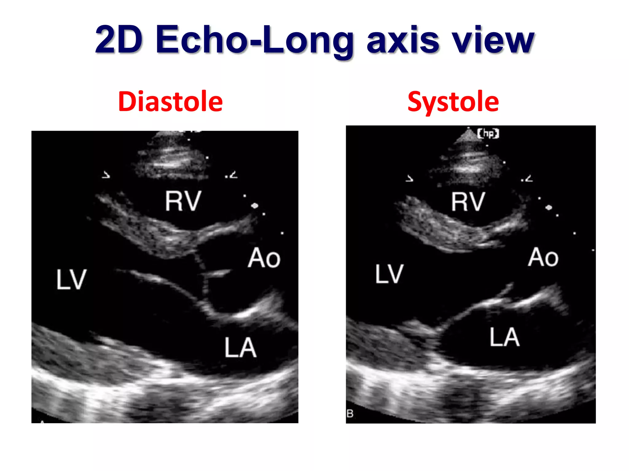 2D Echo-Long axis view 
Diastole Systole 
 