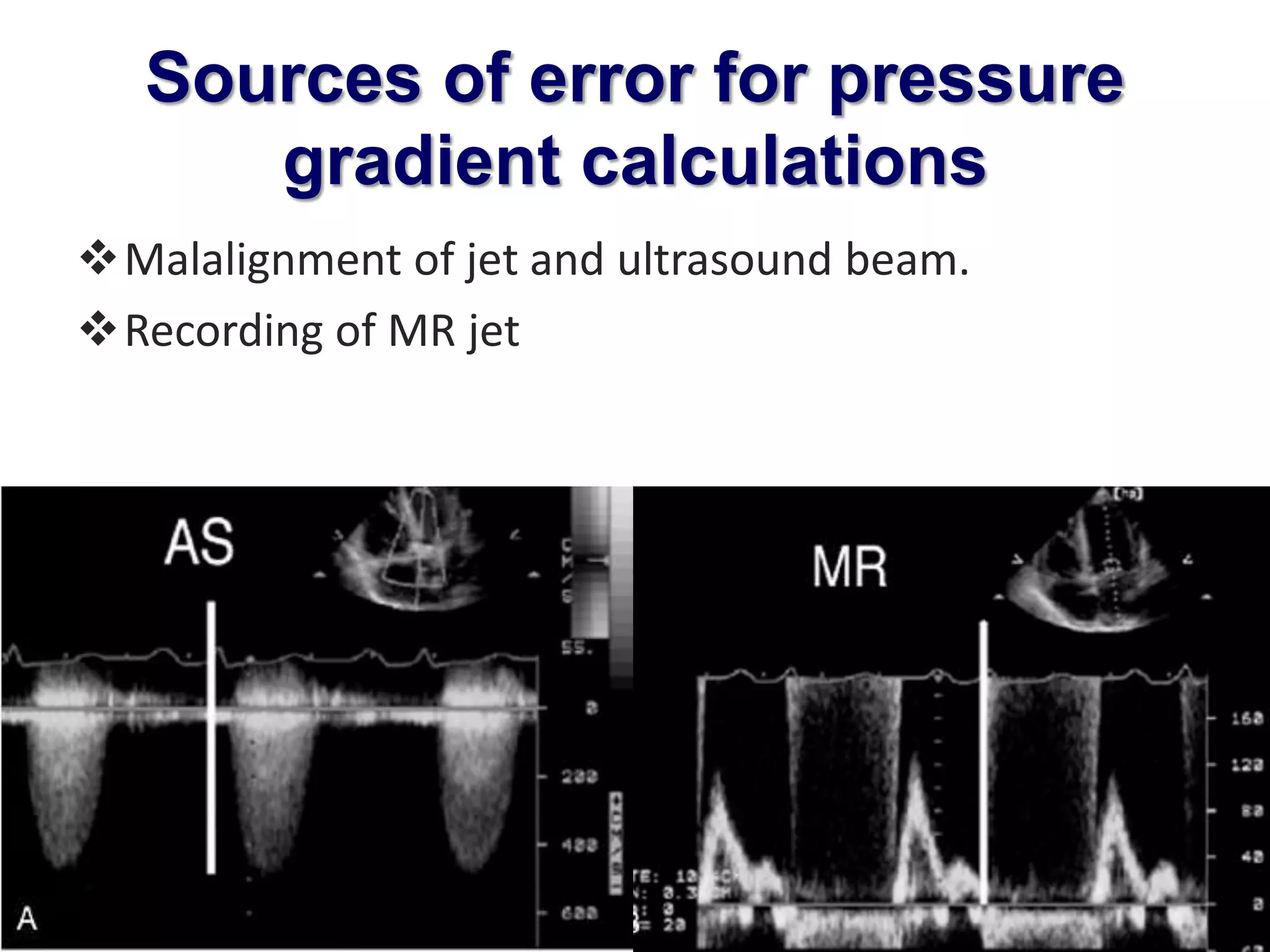 Sources of error for pressure 
gradient calculations 
Malalignment of jet and ultrasound beam. 
Recording of MR jet 
 