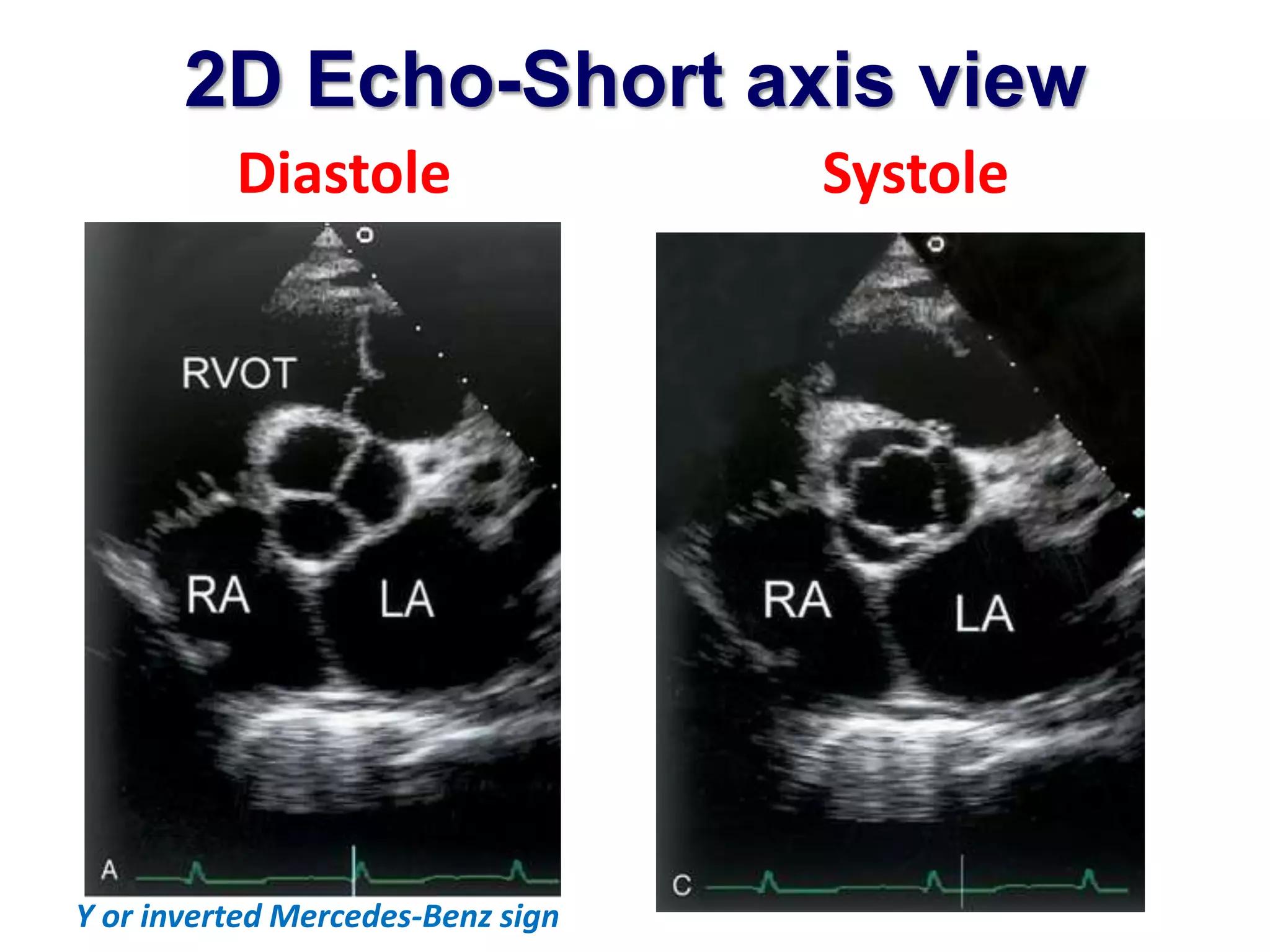 2D Echo-Short axis view 
Diastole Systole 
Y or inverted Mercedes-Benz sign 
 
