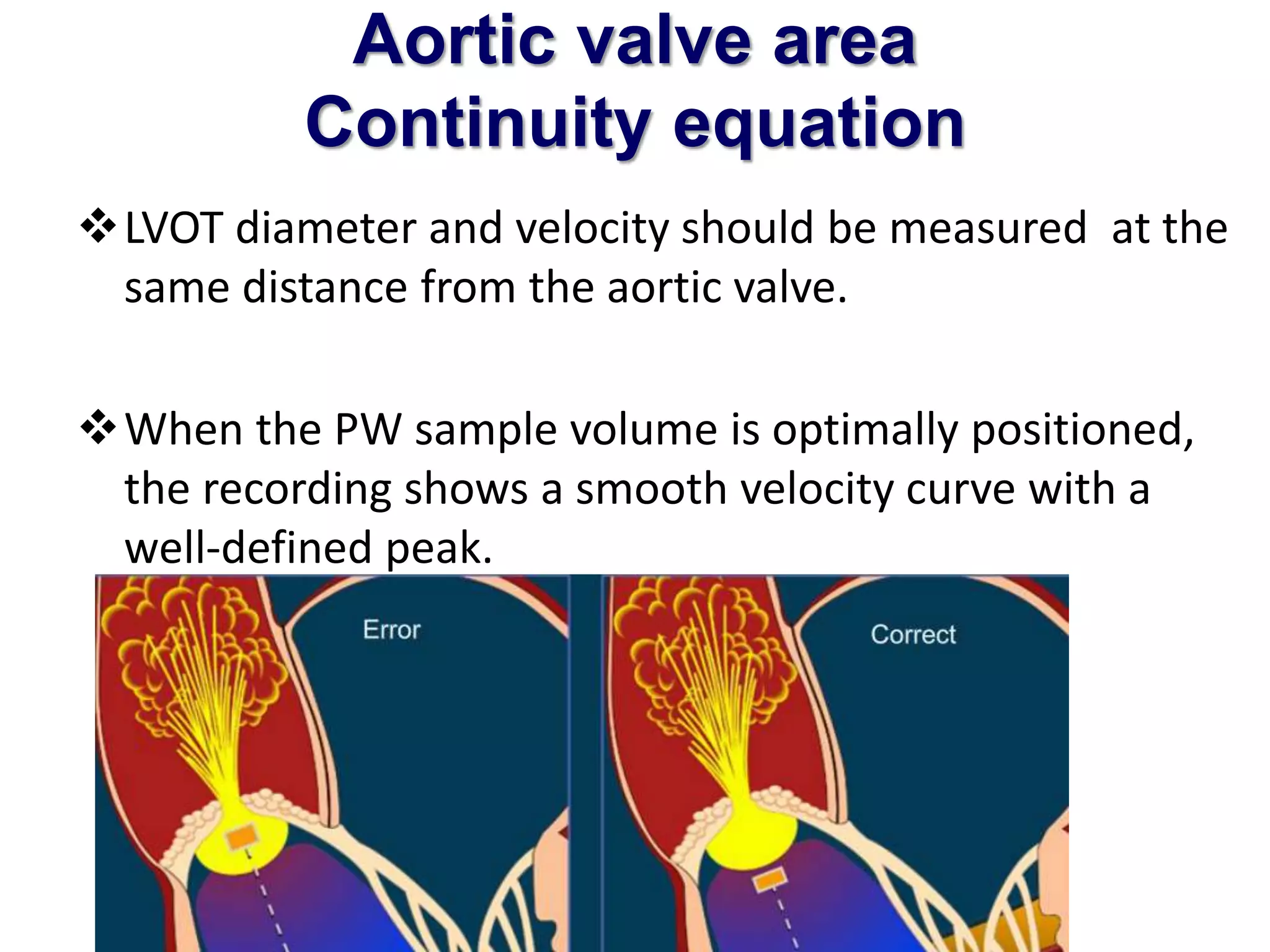 Aortic valve area 
Continuity equation 
LVOT diameter and velocity should be measured at the 
same distance from the aortic valve. 
When the PW sample volume is optimally positioned, 
the recording shows a smooth velocity curve with a 
well-defined peak. 
 