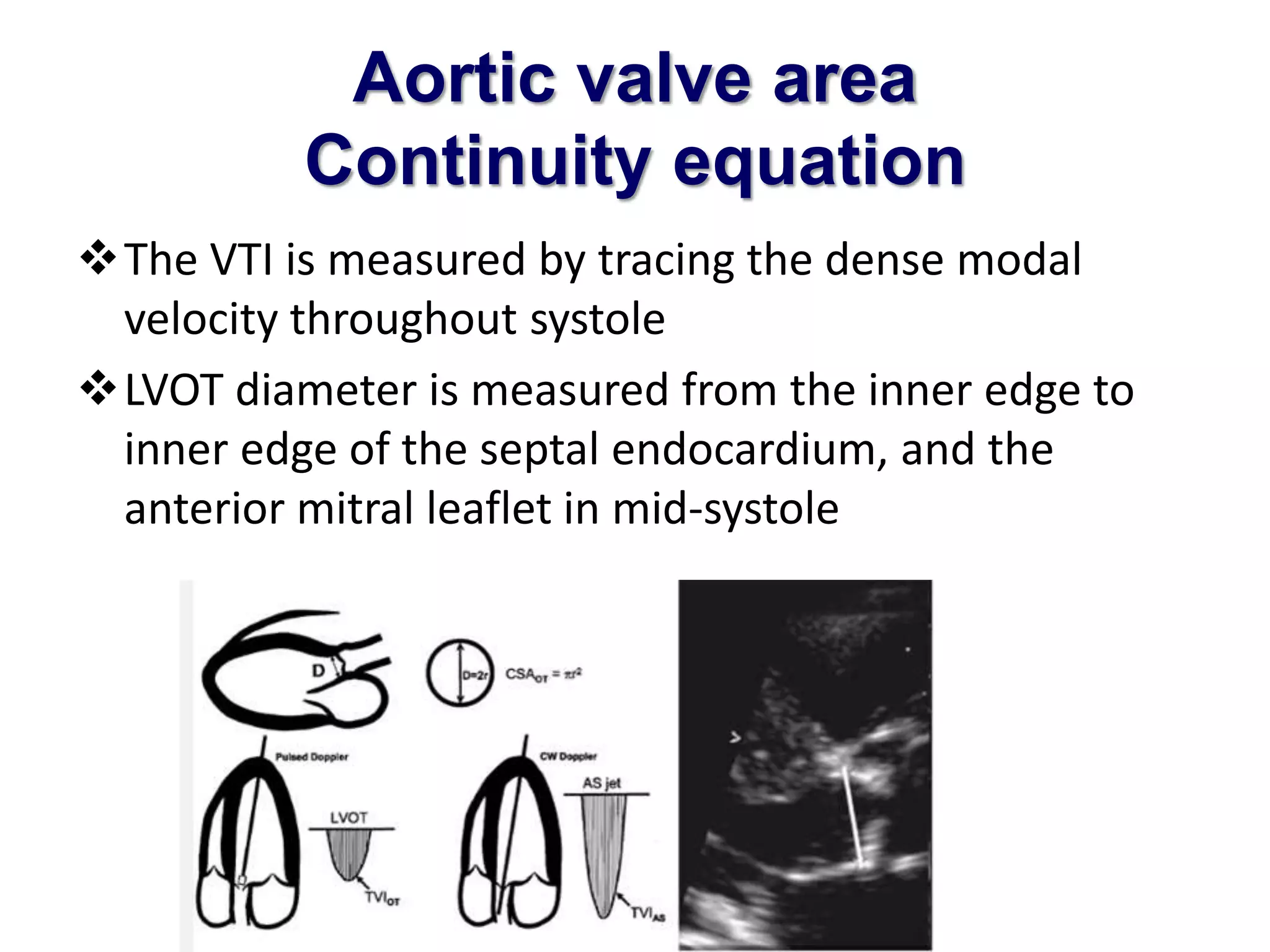 Aortic valve area 
Continuity equation 
The VTI is measured by tracing the dense modal 
velocity throughout systole 
LVOT diameter is measured from the inner edge to 
inner edge of the septal endocardium, and the 
anterior mitral leaflet in mid-systole 
 