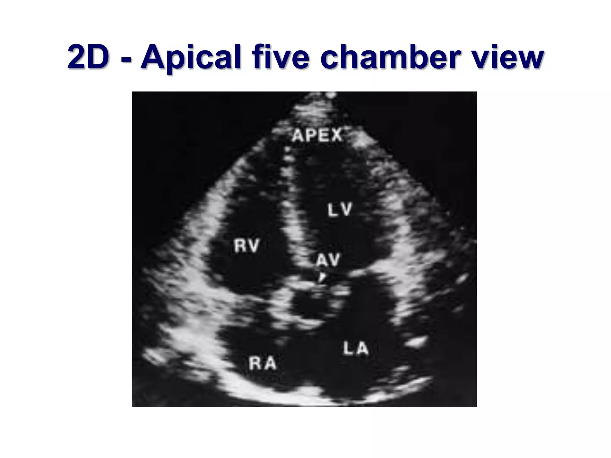2D - Apical five chamber view 
 