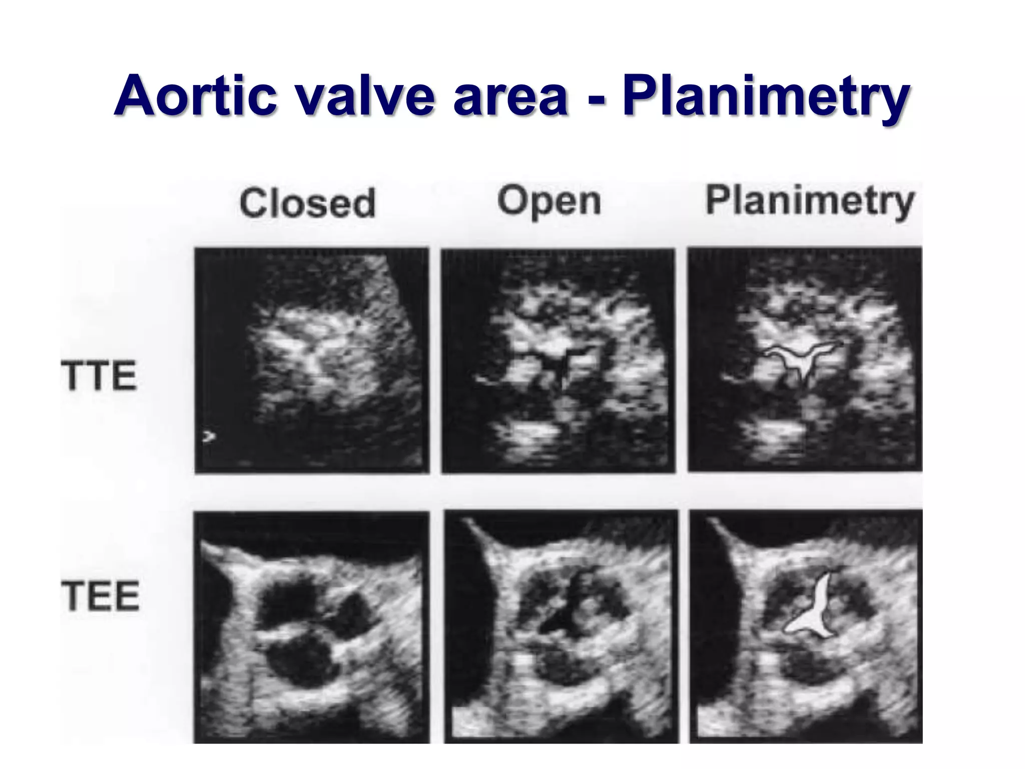 Aortic valve area - Planimetry 
 