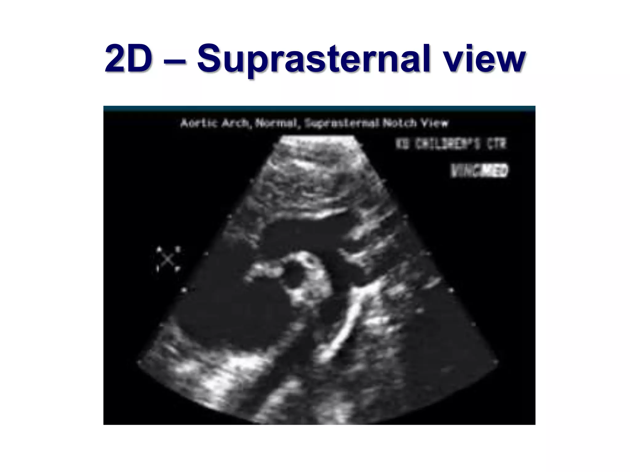 2D – Suprasternal view 
 