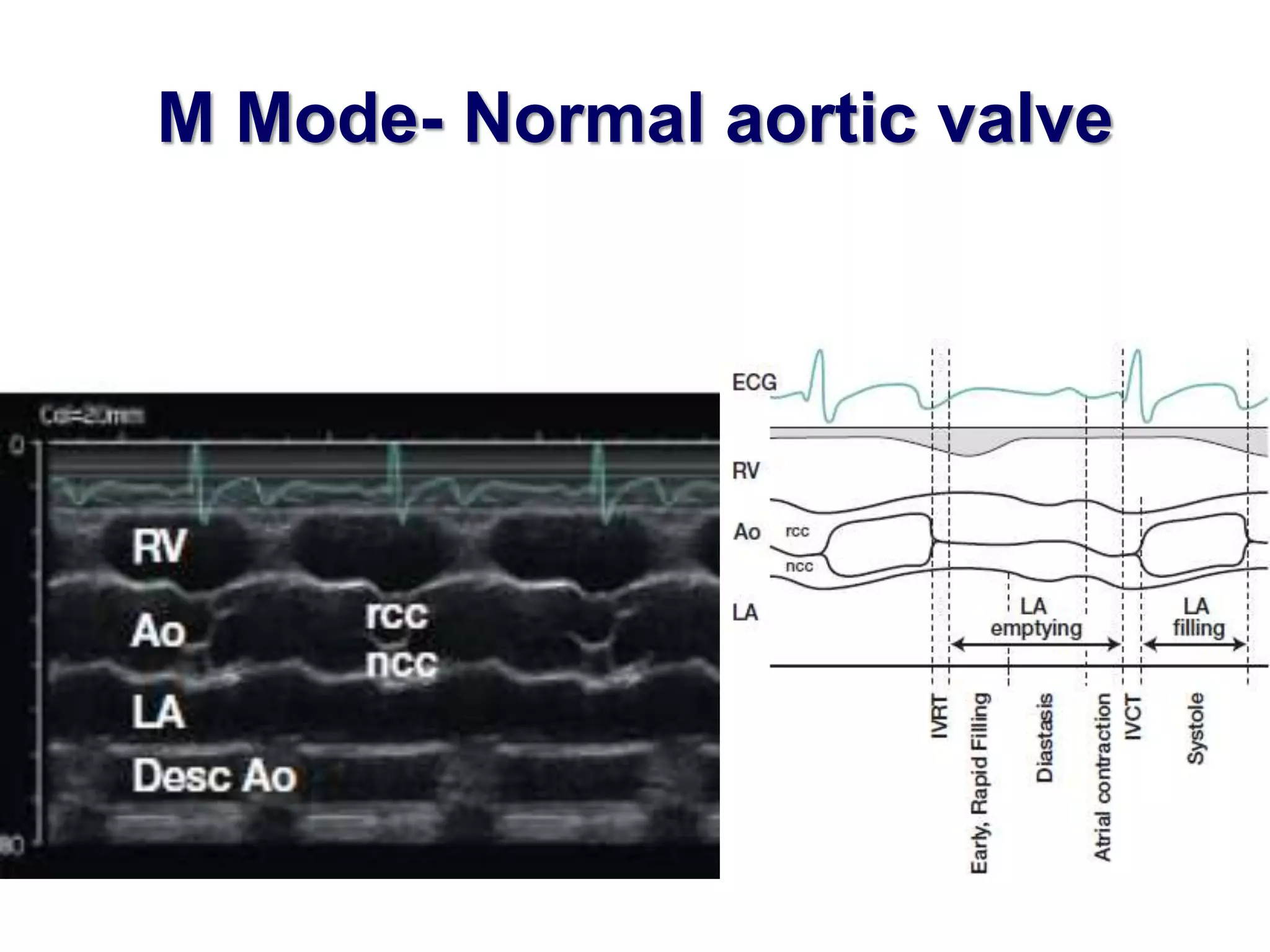 M Mode- Normal aortic valve 
 