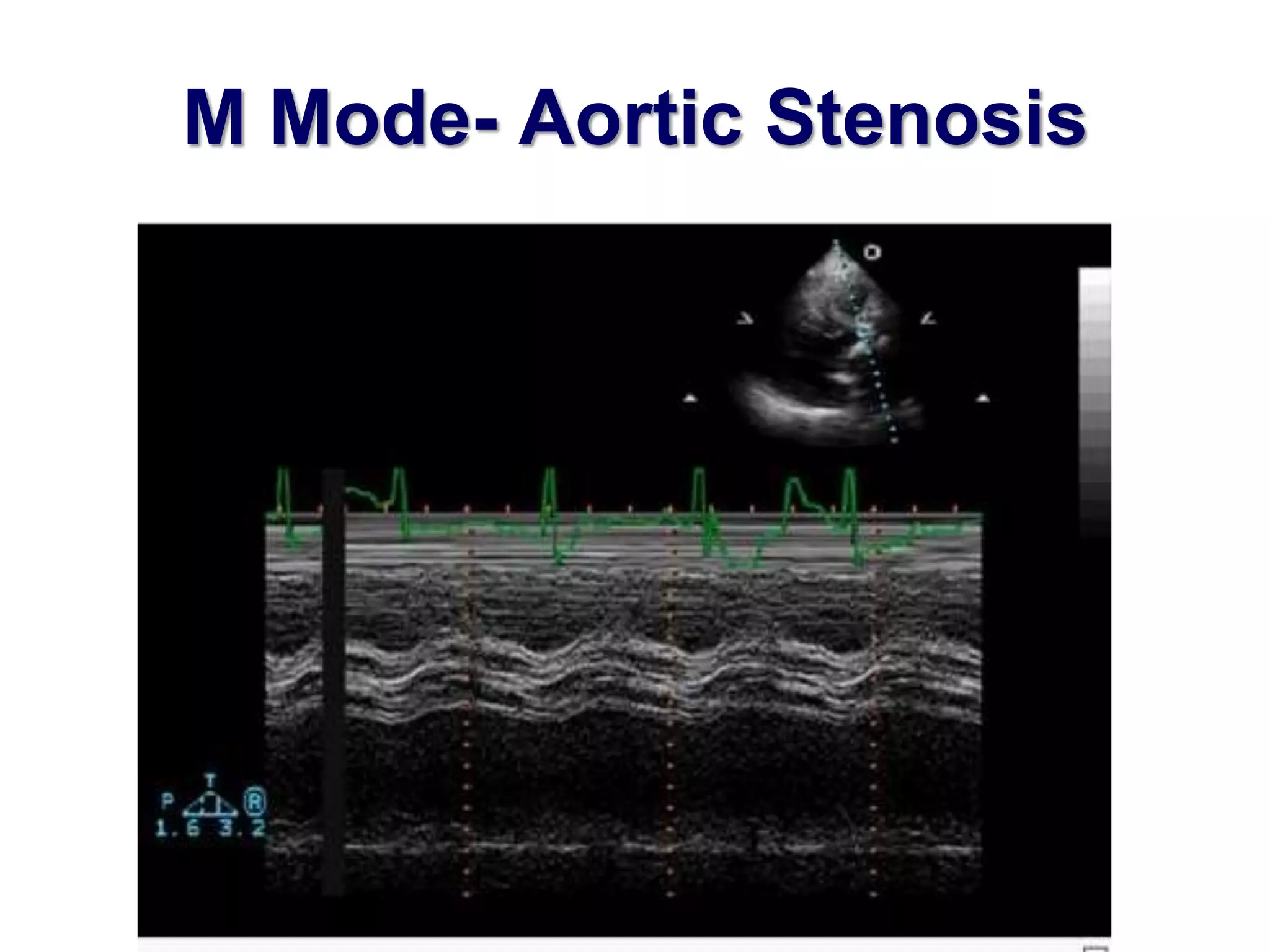 M Mode- Aortic Stenosis 
 
